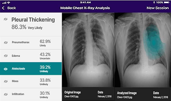 Mobile Chest X-Ray Analysis showcasing its ability to identify different types of lung issues based on an x-ray image.