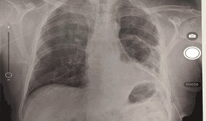 Photo of a chest x-ray.